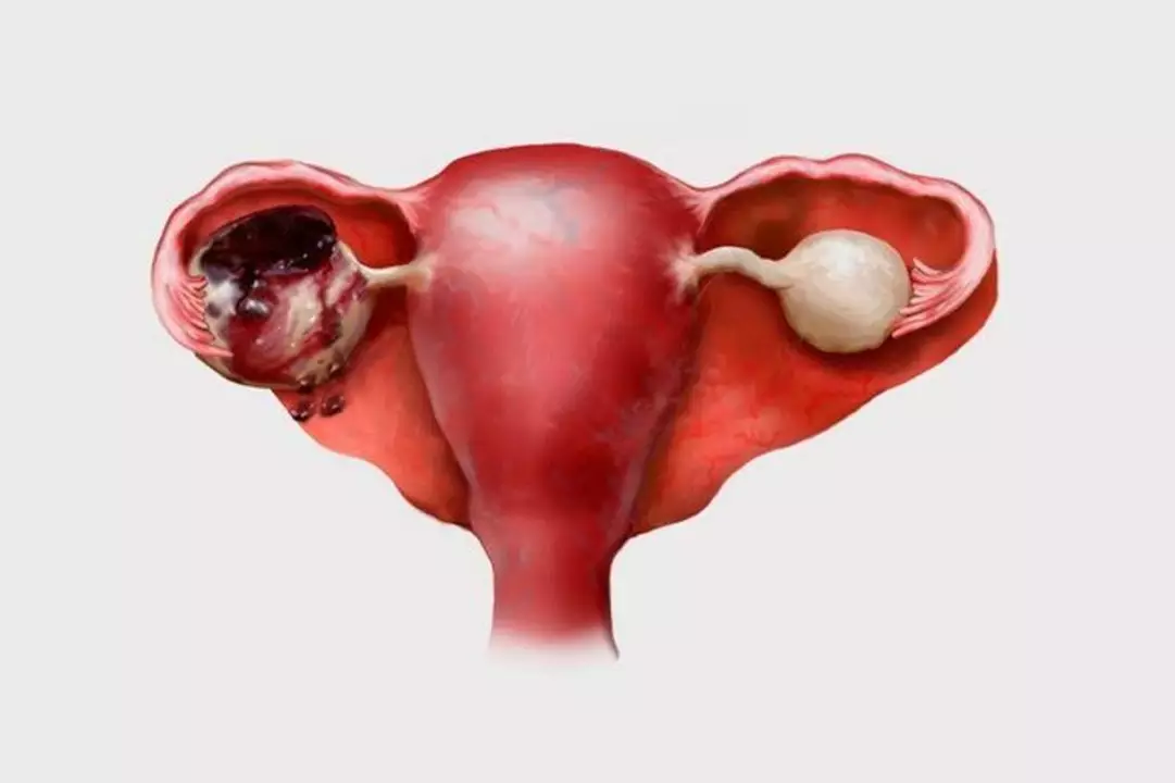 La relación entre la falta de progesterona y la endometriosis