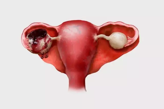 La relación entre la falta de progesterona y la endometriosis